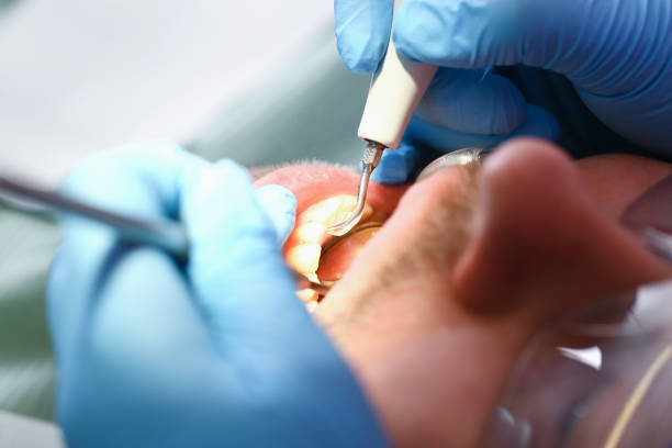 Best Emergency Wisdom Teeth Removal in Leesburg, VA